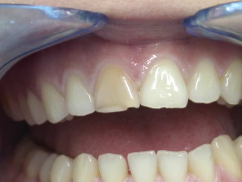 Rehabilitación del incisivo central superior en Clínica Dental Odontic.