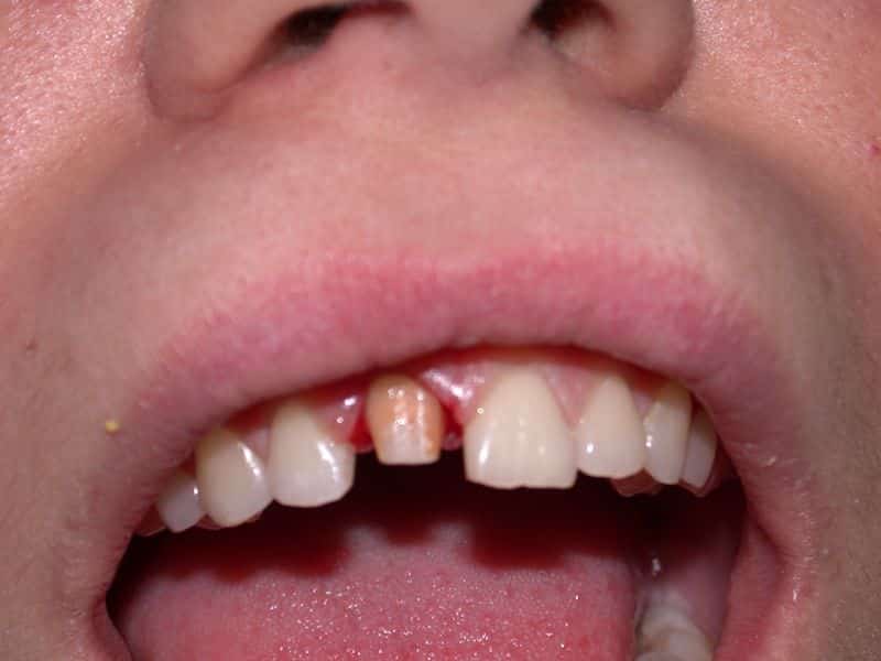 Rehabilitación del incisivo central superior en Clínica Dental Odontic.